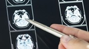 Brain MRI Interpretation