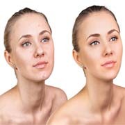 Skin Retouching Services Skin Retouching Services