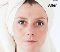 Blemishes and Marks Removal After