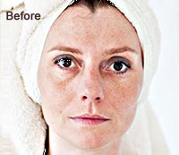 Blemishes and Marks Removal Before