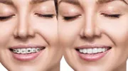 Braces Removal