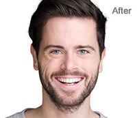 Red-eye Removal After