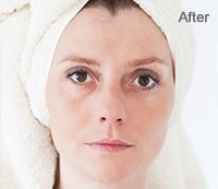 Removing Dark Spots After