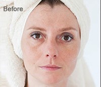 Removing Dark Spots Before