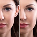Wrinkle and Spots Removal